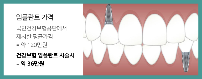 임플란트