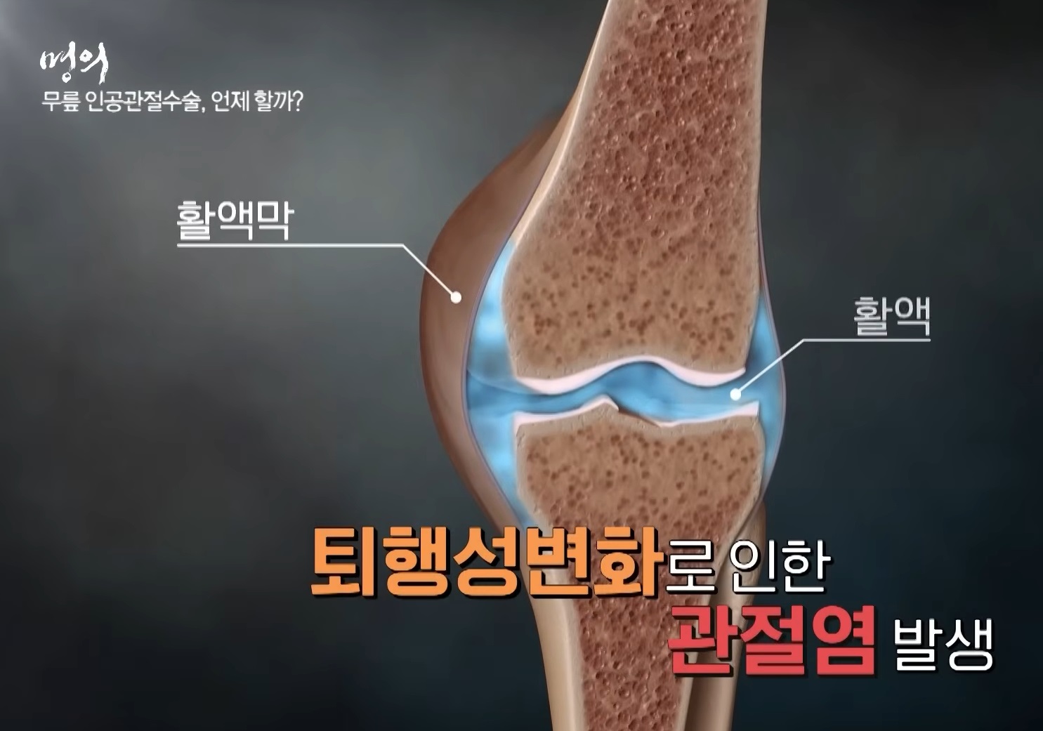 명의-무릎-김성환-교수
