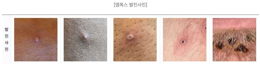 엠폭스 증상 관련주