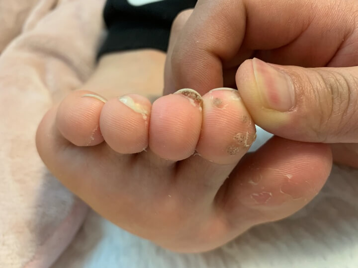 발톱-사이-족저-사마귀