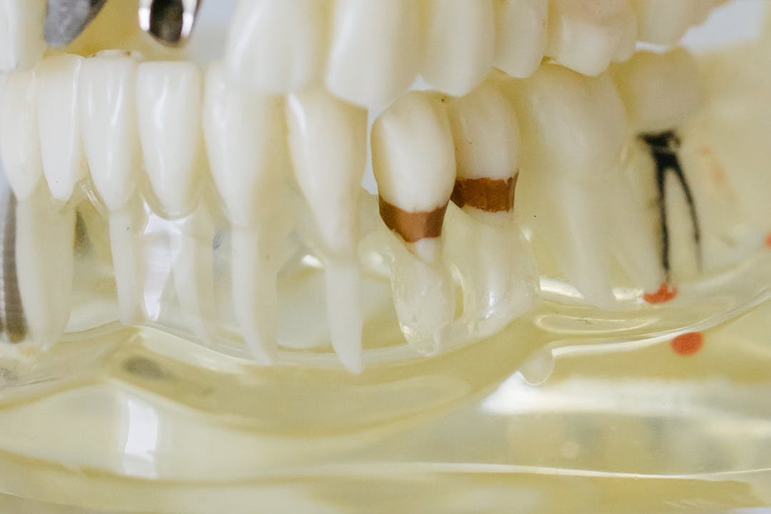 임플란트의 종류에 관련된 사진2