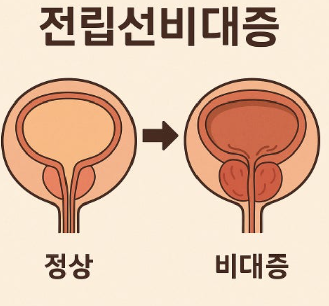 전립선 비대증