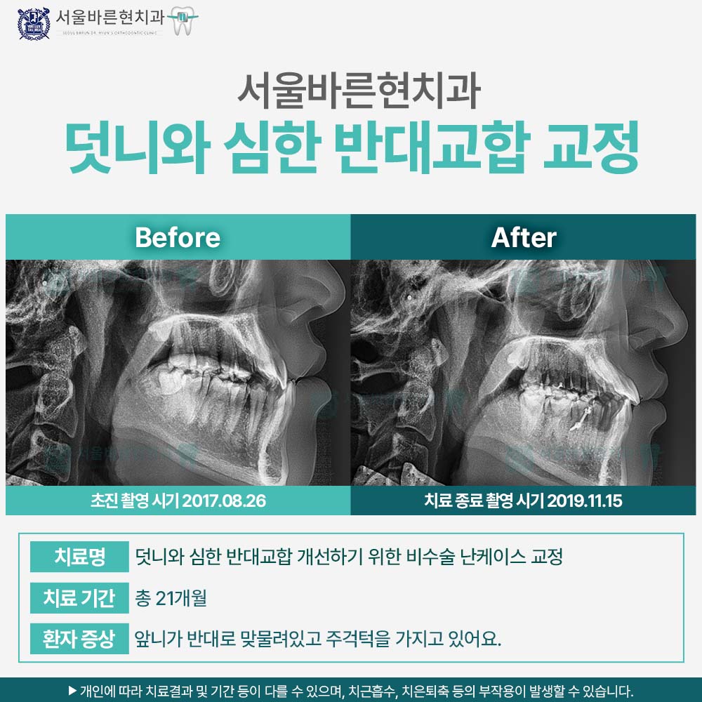 부산치아교정