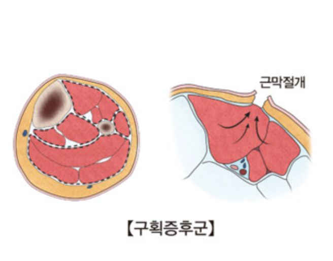문근영 괴사 고백 '급성구획증후군' 증상 원인 골든타임 재활법 완벽 정리