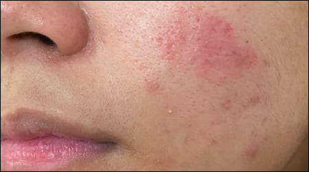 얼굴에 발진
