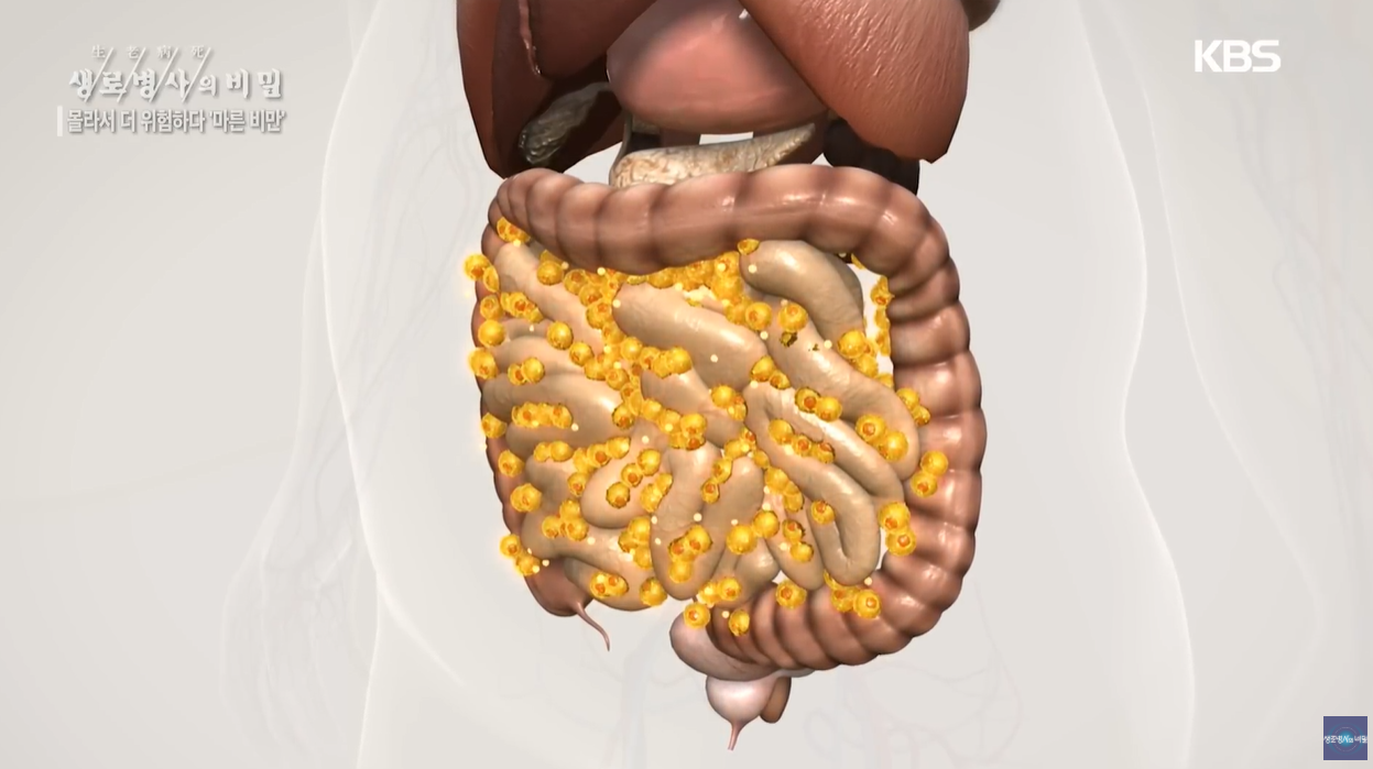 BMI 체질량지수 마른비만 체지방률 내장지방 간식중독 지바간 당뇨병 뇌졸증 수면무호흡 식습관