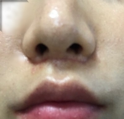 인중 축소 수술 후기