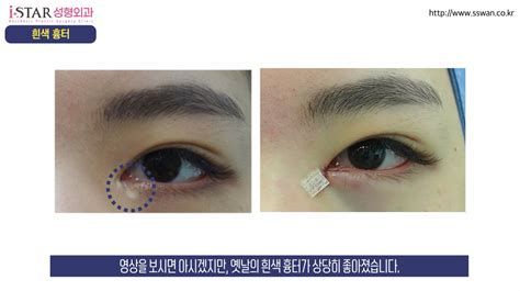 눈꼬리 내리기