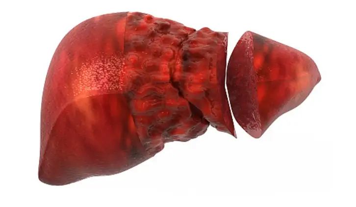 감마지티피 수치가 높을 때 나타나는 증상