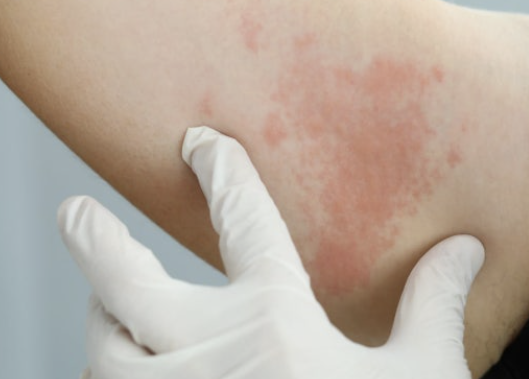 면역 불균형 두드러기 관리하는 법