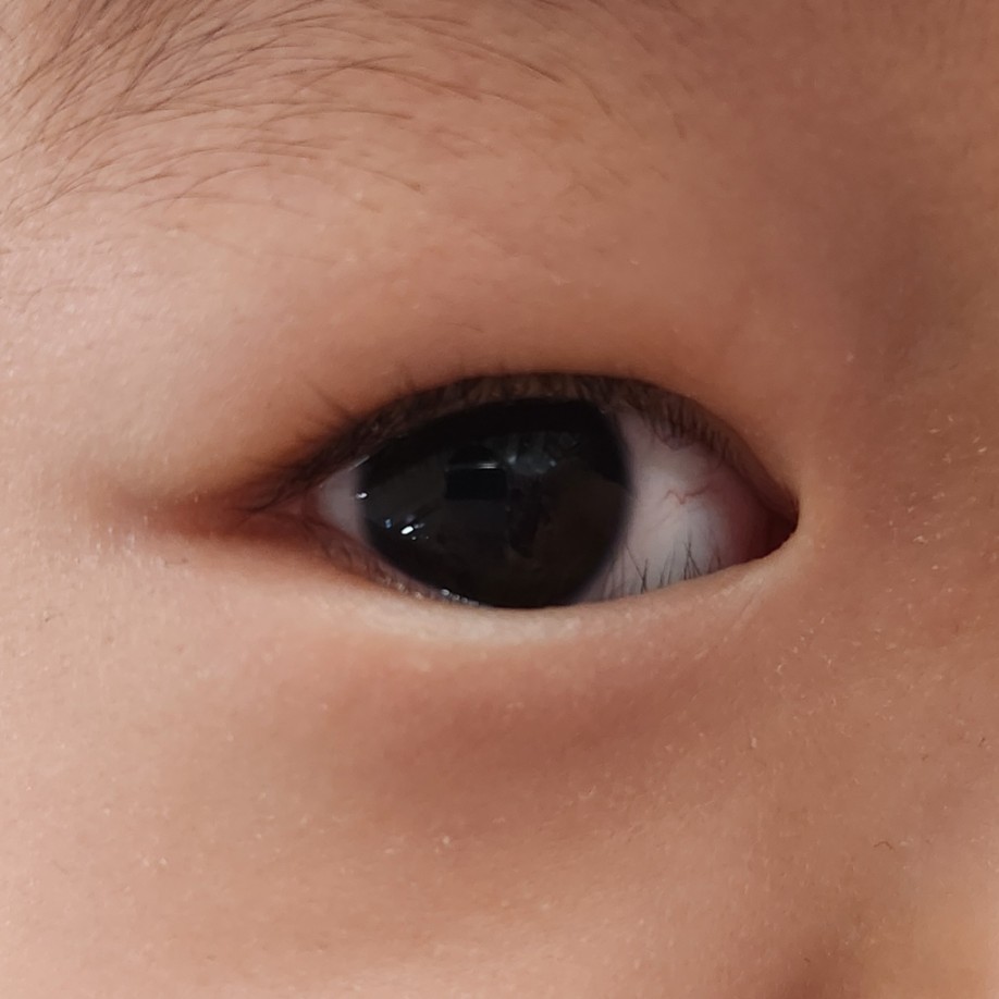 아래 속눈썹이 눈을 찌르는 모습