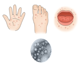 아기들이 자주 걸리는 수족구, 어떻게 예방하고 대처할까요?