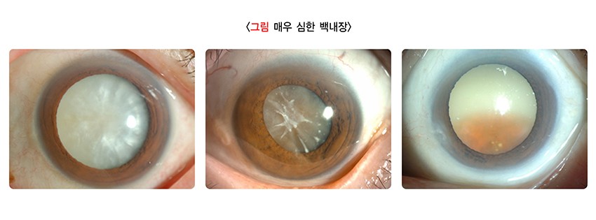 백내장