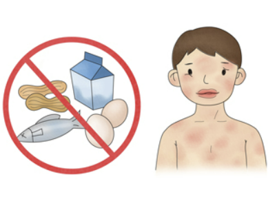 지연성 알러지 검사 증상&amp;#44; 원인&amp;#44; 검사 비용 총정리