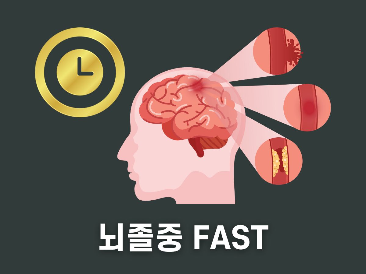 뇌졸중 FAST 법칙