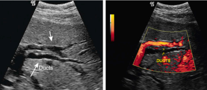intrahepatic duct measurement (left)