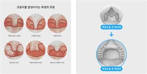 코골이 고치는 법