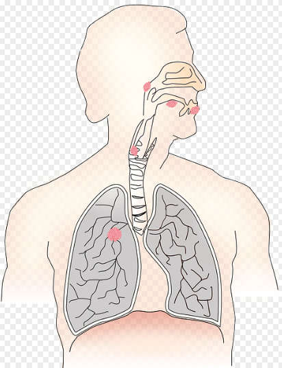 암환자 의료비 지원금