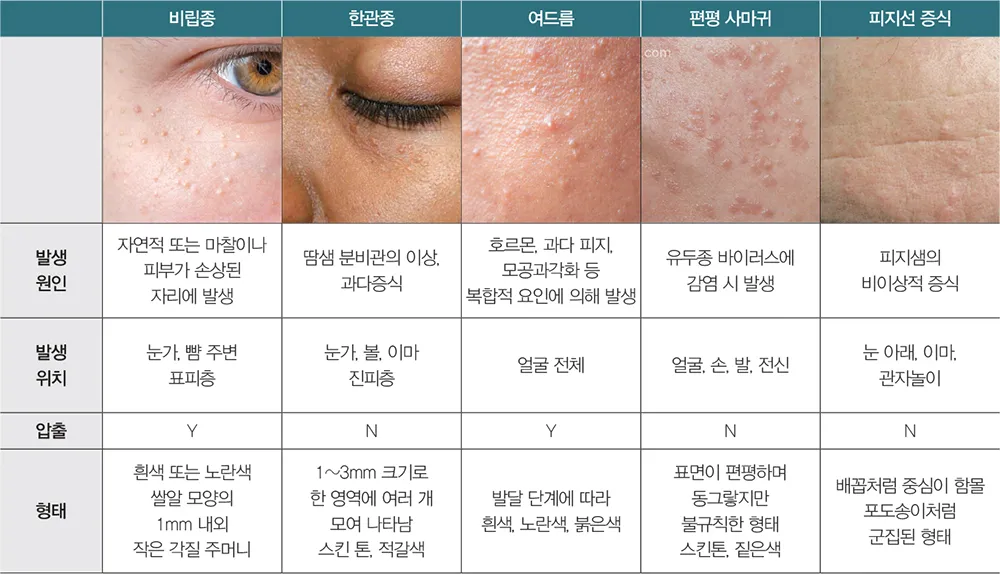 얼굴 비립종 없애는 법 자극 없이 제거하는 피부관리법_6