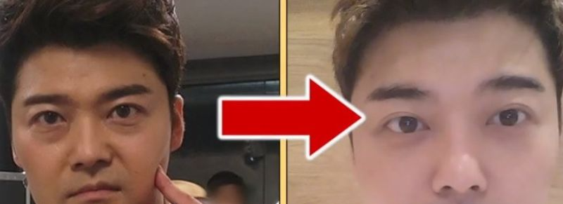 눈밑 지방 유무의 차이