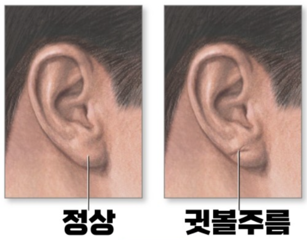 뇌졸중 전조증상 귀주름