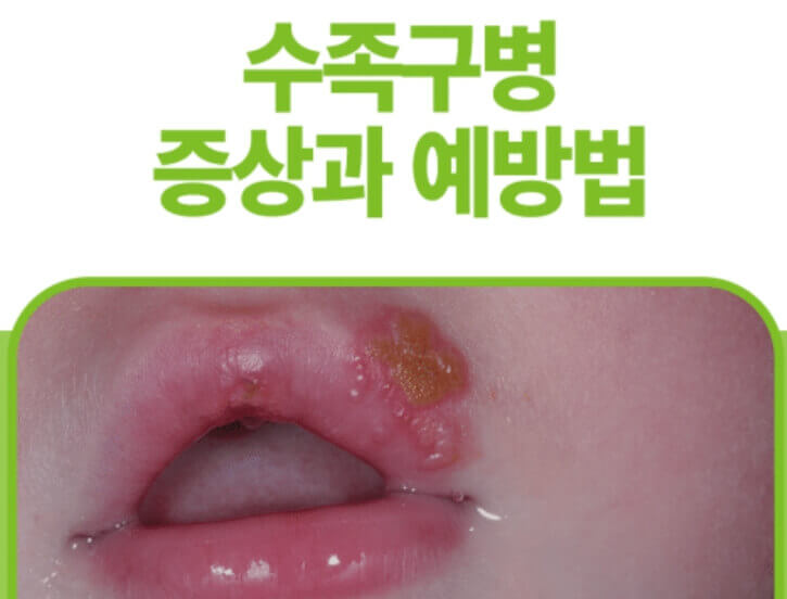 수족구병 증상 및 예방