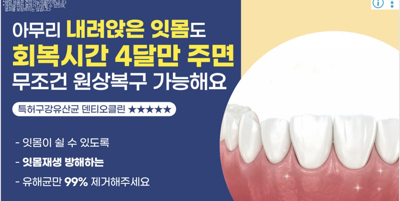 50대 잇몸 내려앉음 걱정된다면?