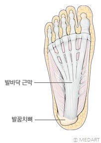 족저근막 