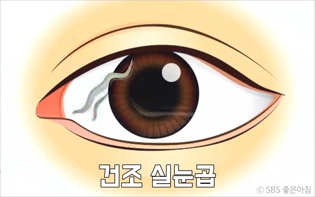 건조한 실눈곱이 끼는 이유 눈질환 안구건조증 눈건조증 증상, 건강 팁줌 매일꿀정보