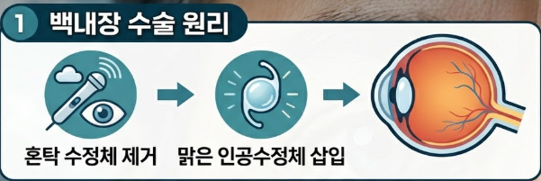 백내장 수술후 시력회복 기간
