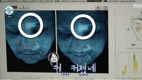 ‘나 혼자 산다’ 구성환의 백반증 투병 이야기