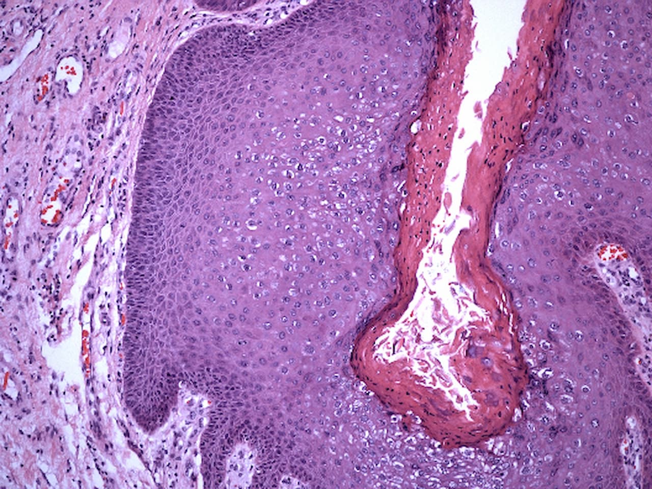 사마귀는 자연적으로 없어질 수 있습니다