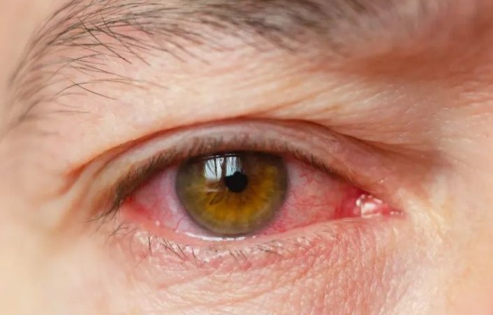 눈에 이물질이 낀것 같은 증상