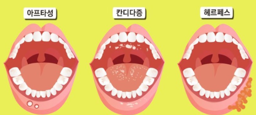 구내염의 종류