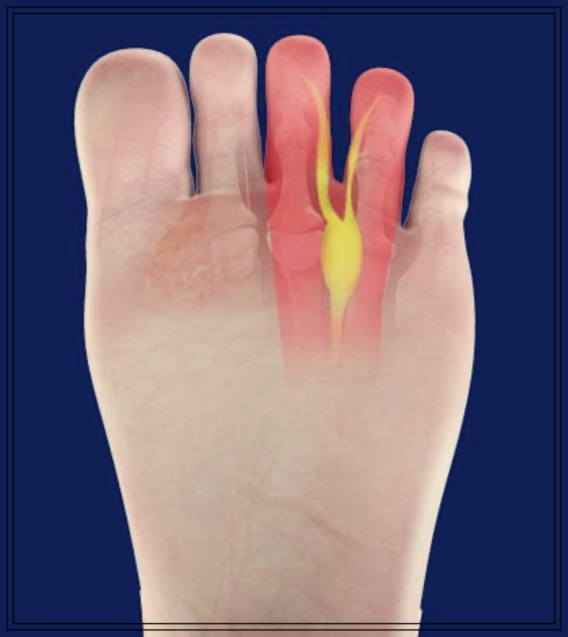 발바닥 고통, 그 원인은? 지간신경종의 정체와 치료법.