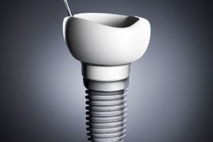 용인시-처인구-임플란트-치과-가격-비용-싼-곳&amp;#44;저렴한-곳&amp;#44;잘하는-곳&amp;#44;유명한-곳-BEST20-추천19