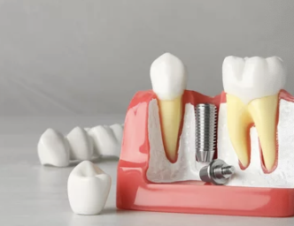 임플란트 모형 사진