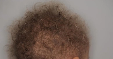 양모모발증후군 뜻 증상 원인 선천성 유전 양털모발증후군 총정리 1