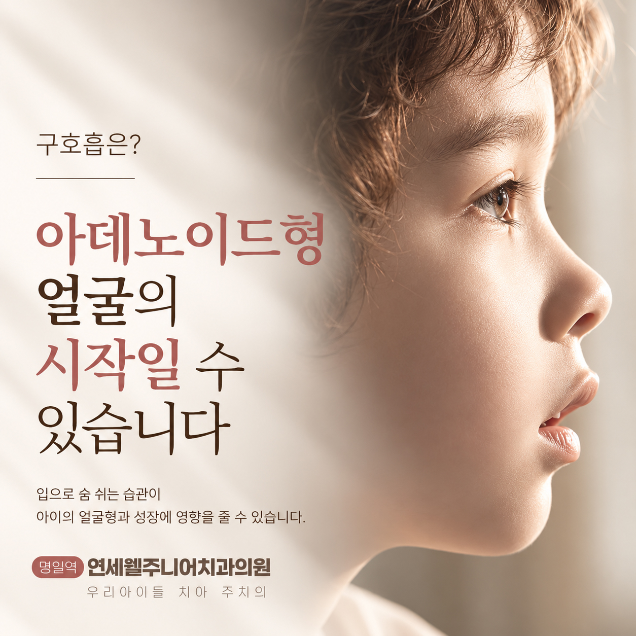 입을 벌리고 있는 어린이의 측면 모습으로 구호흡과 아데노이드형 얼굴의 연관성을 설명하는 이미지
