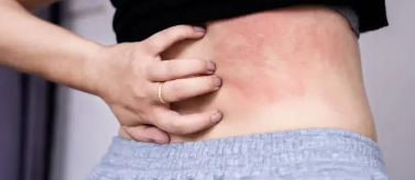 아토피 원인&amp;#44; 증상&amp;#44; 치료법 총 정리 (2025 ver.)