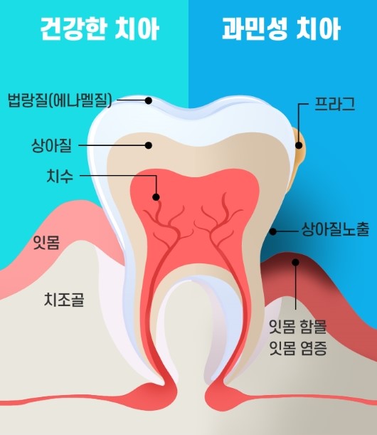 건강한 치아와 과민성 치아의 구조
