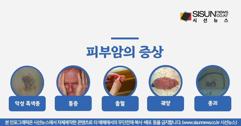 피부암