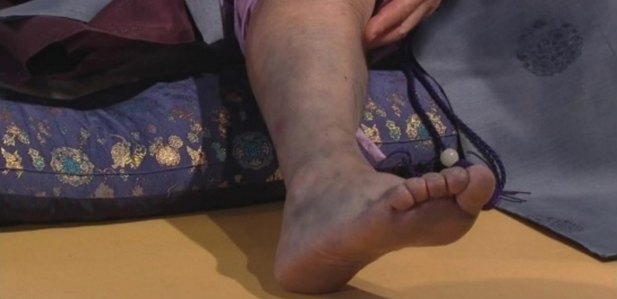 오른쪽 발과 다리에 탈저로 인해서 피부가 검붉은 색으로 변한 것을 찍은 사진