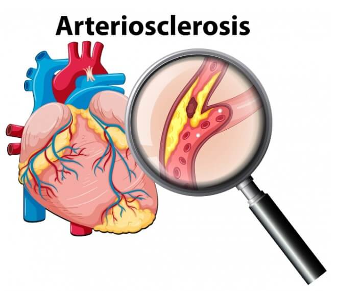 혈관 속 노페물의 정도