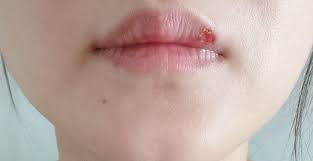 입술 포진 빨리 낫는법