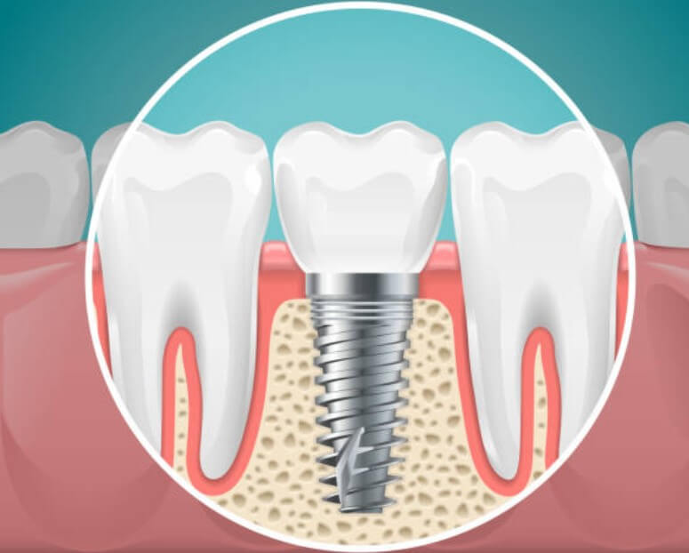 광주 임플란트 치과 잘하는 곳 
