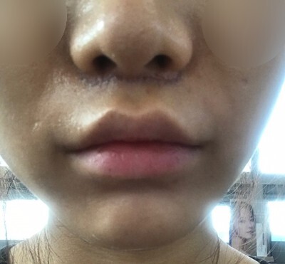 인중 축소 수술 후기