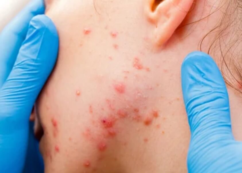 대상포진 초기증상 대상포진 조기치료 대상포진 초기증상 및 조기치료