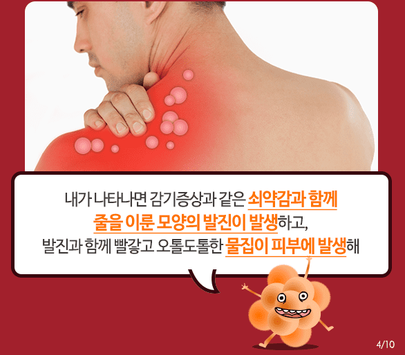 대상포진 증상 중 하나인 물집 발생