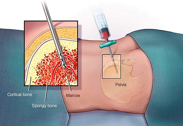 골수형성이상증후군 MDS 치료 방법